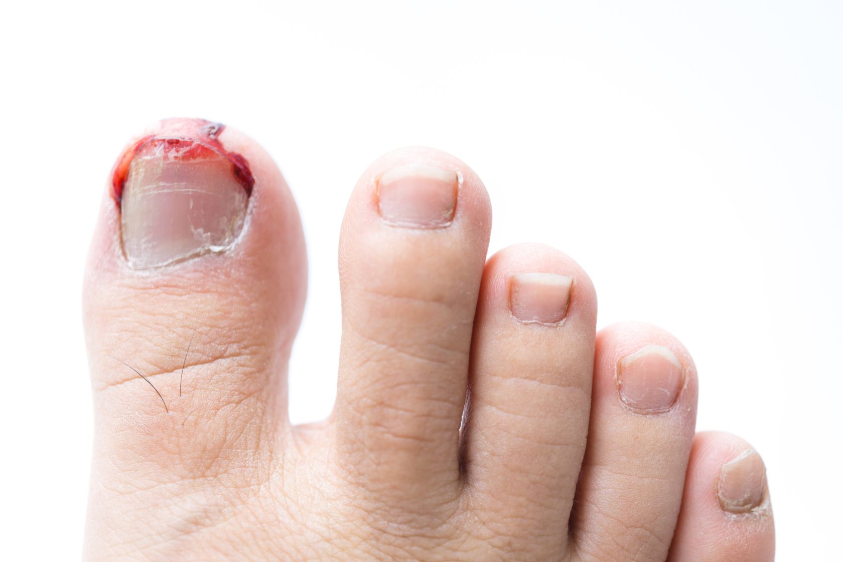 ingrown-nail