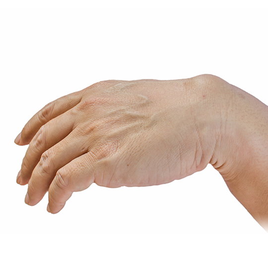 Ganglion-cyst